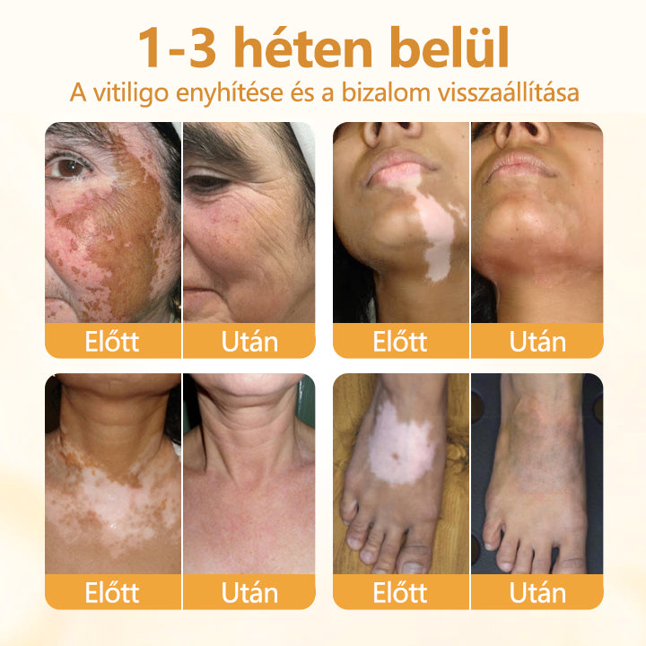 Laleia® VitiCalm méhméreg-krém🌻🌻
