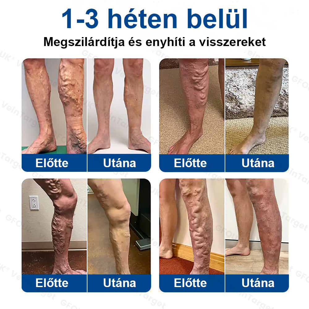 ✅✅Laleia® Vein Ease mikrotűs tapasz