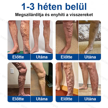 ✅✅Laleia® Vein Ease mikrotűs tapasz