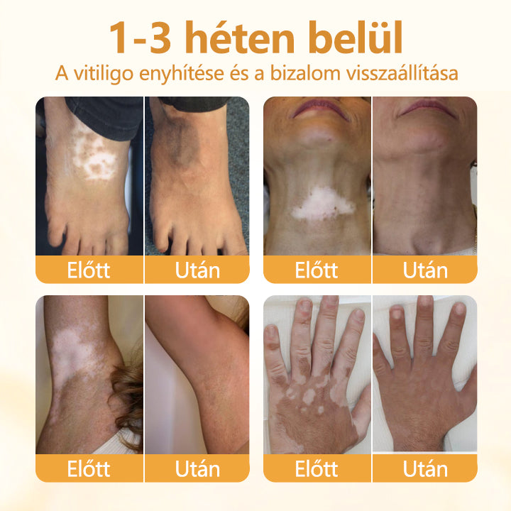 Laleia® VitiCalm méhméreg-krém🌻🌻
