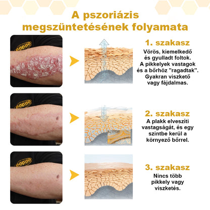 🌿🌿Laleia® PsoriaSoothe Méhméreges Bőrregeneráló Krém
