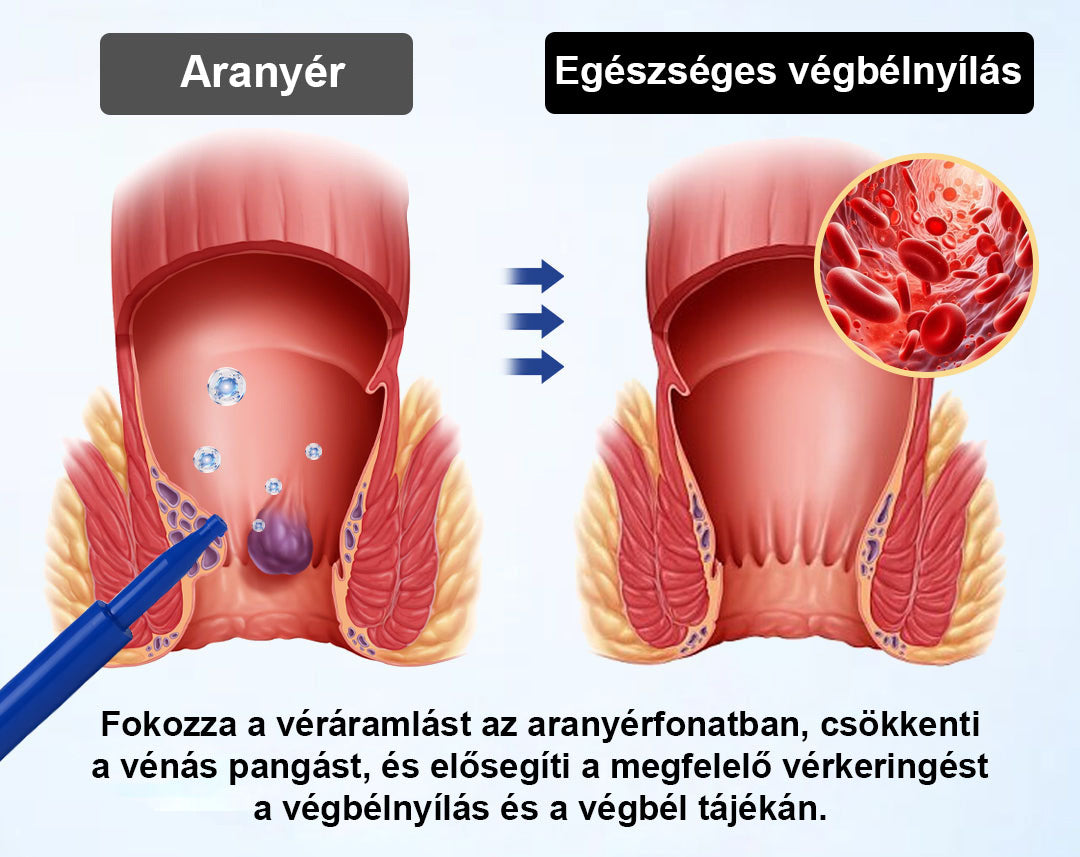 🌿 Timilk® ProctoEase nyugtató aranyérápoló gél