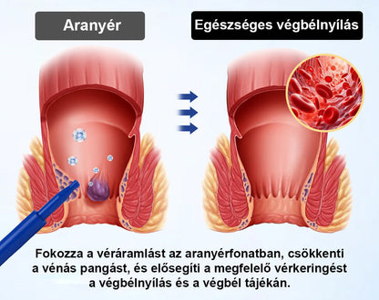 🌿 Timilk® ProctoEase nyugtató aranyérápoló gél