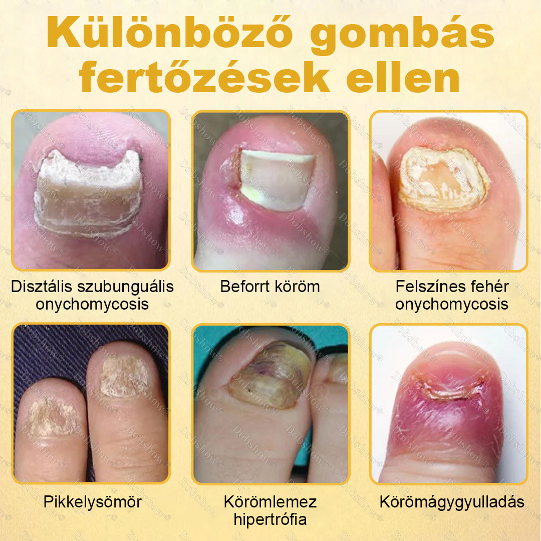 🌿 Laleia® Méhméreg Körömmentő Spray