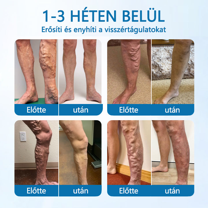 Laleia® VeinGuard Herbal Spray-✅✅✅ Klinikailag bizonyítottan 7 nap alatt megszünteti a visszerességet!