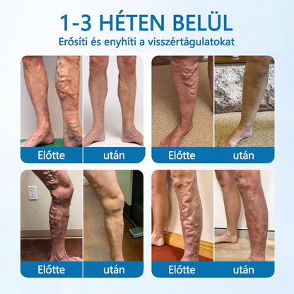 Laleia® VeinGuard Herbal Spray-✅✅✅ Klinikailag bizonyítottan 7 nap alatt megszünteti a visszerességet!