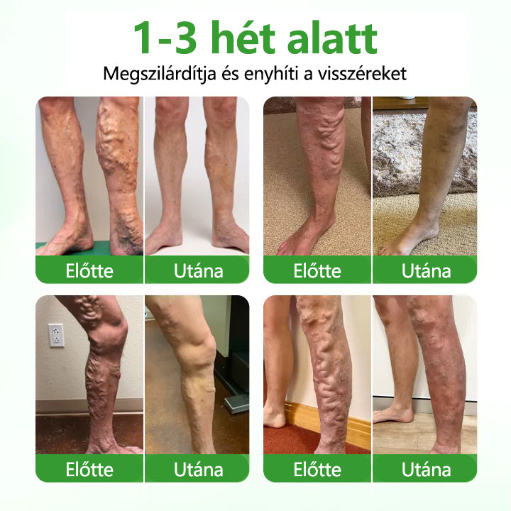 🔥🔥🔥Laleia® VeinHeal mikrotűs tapasz