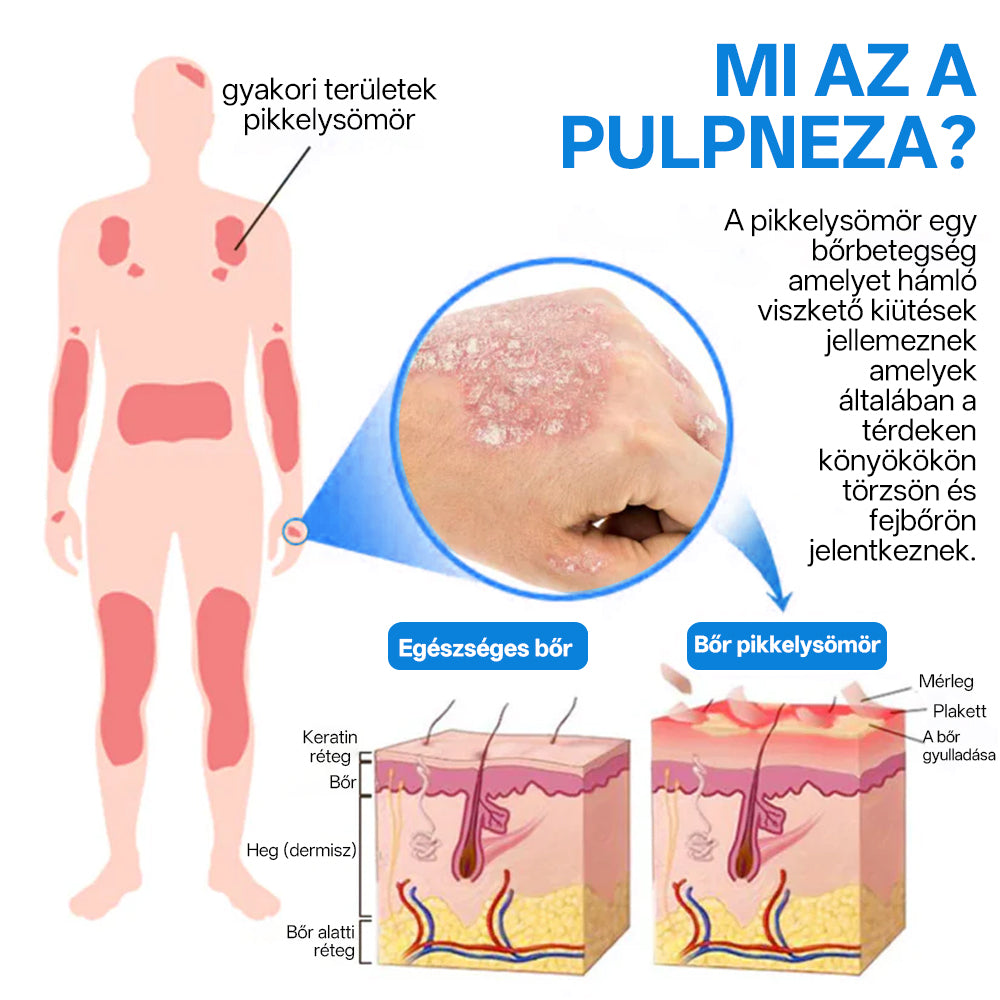 ⭐⭐⭐Laleia® 🎉Magnézium Gyógynövényes Pszoriázis Spray