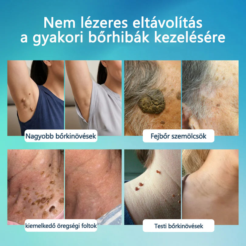 Timilk® SpotlessPro Fejlett Bőrápoló Toll