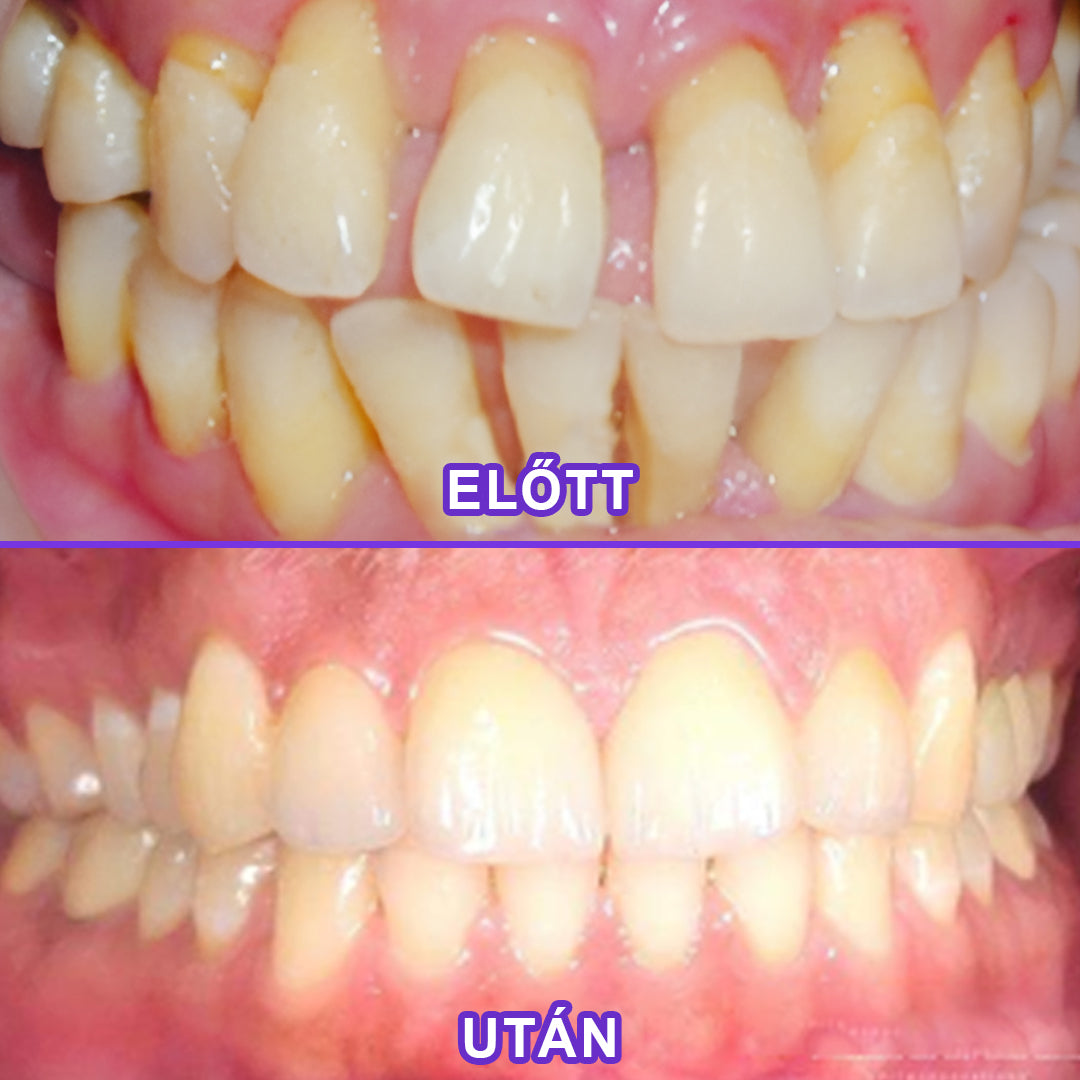 ⭐Laleia® SensiGum Fluoridos Fogkrém