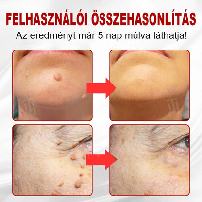 🥇🥇 🥇Laleia® WartAway Pro tapasz