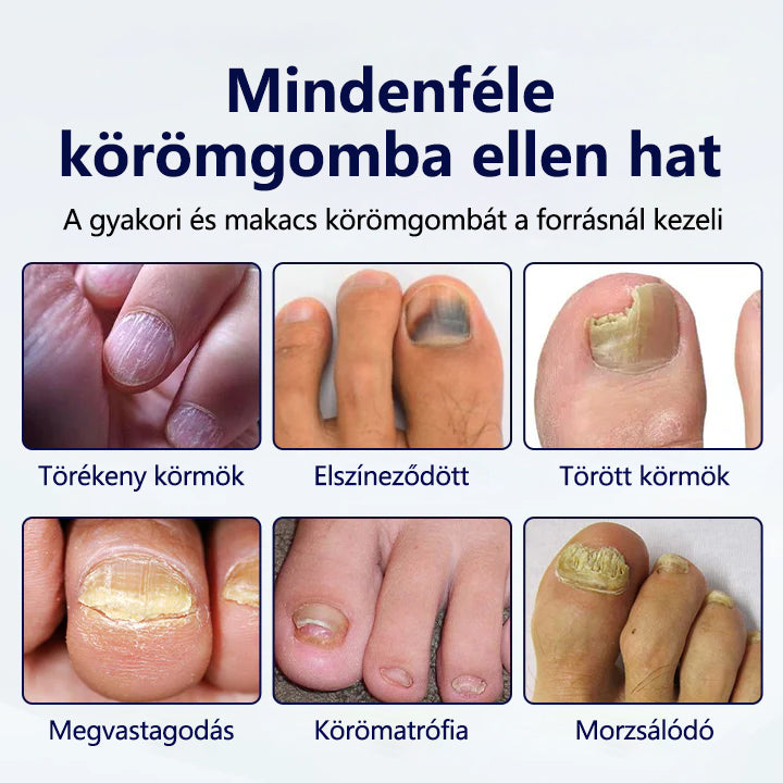 🔥🔥Laleia® Gombaellenes körömjavító tapasz