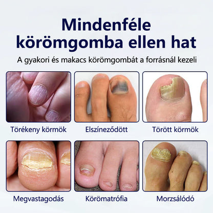 🔥🔥Laleia® Gombaellenes körömjavító tapasz