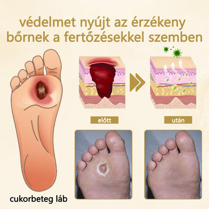 ✅Laleia® Diabetikus lábgyógyító spray - Méhméreggel átitatott
