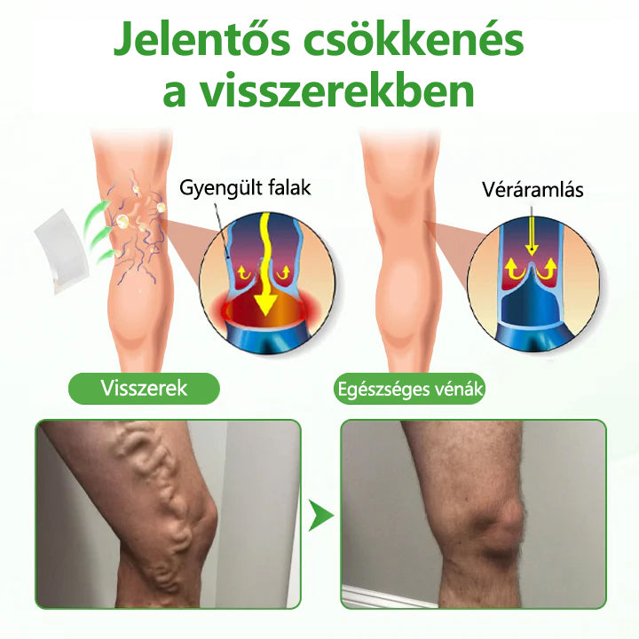 🔥🔥🔥Laleia® VeinHeal mikrotűs tapasz