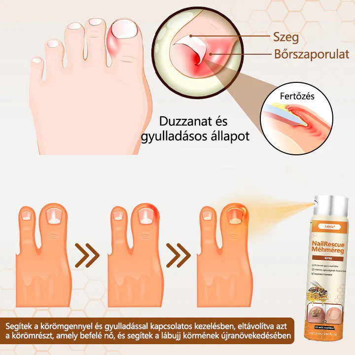 ✅✅✅Laleia® NailRescue méhméreg spray