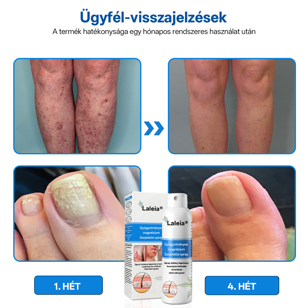 ⭐⭐⭐Laleia® 🎉Magnézium Gyógynövényes Pszoriázis Spray