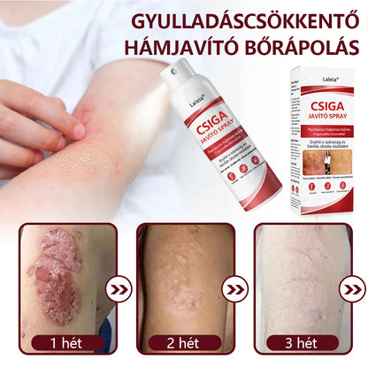 🔥🔥Laleia® csigahéjas spray viszkető, hámló pikkelysömörös bőrre