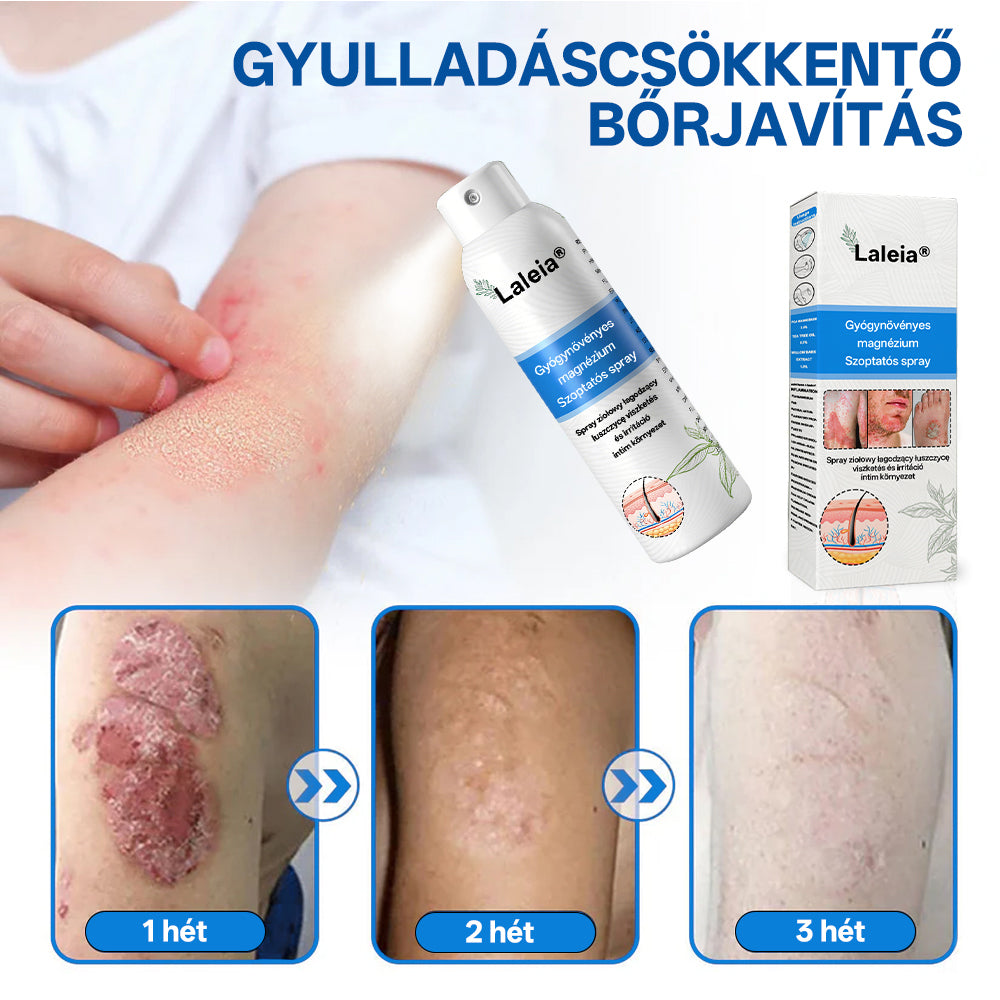 ⭐⭐⭐Laleia® 🎉Magnézium Gyógynövényes Pszoriázis Spray