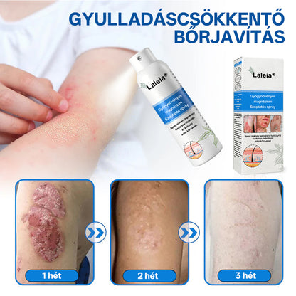 ⭐⭐⭐Laleia® 🎉Magnézium Gyógynövényes Pszoriázis Spray